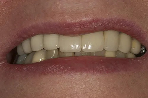 Smile with the final bridge in situ