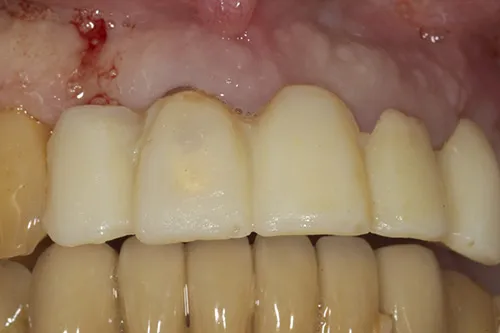 Before treatment: An implant bridge, with temporary teeth at every stage