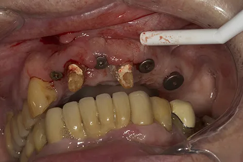 Implants placed in situ and healing