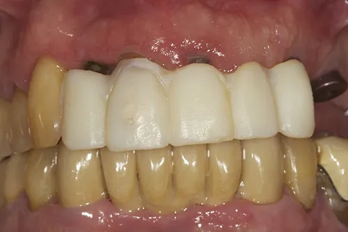 Tooth supported temporary bridge in situ with implants healing underneath