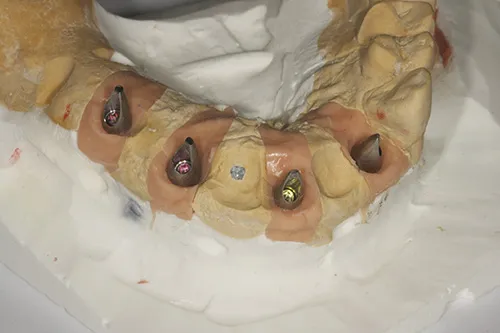 Impressions taken and model made for implant supported temporary bridge