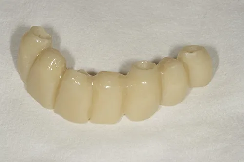 Temporary implant supported bridge