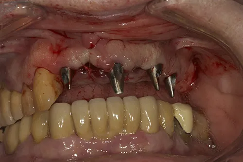 Failing teeth extracted permanent abutments connected to implants