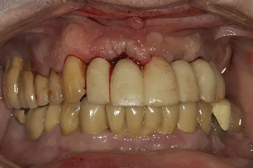 Temporary implant supported bridge in situ