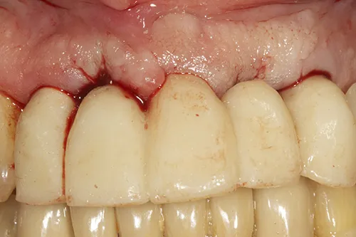 Temporary implant supported bridge used to develop emergence profile of gum for final bridge fabrication