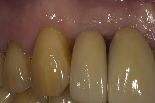 Post-op retracted view of the upper right incisors (UR1 and UR2)