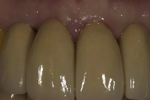 Post op retracted front teeth