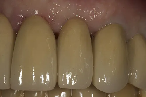Post-op retracted view of the upper left incisors (UL1 and UL2)