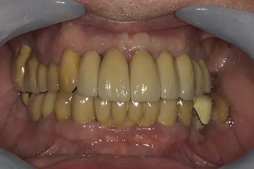 After treatment: An implant bridge, with temporary teeth at every stage