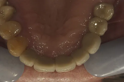 Post op bridgework underside