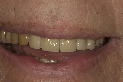 Post op smile