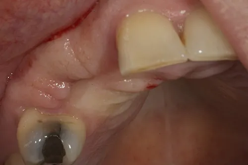Before treatment: Replacing missing teeth with an implant-supported bridge