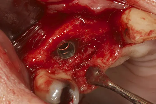 Implant fixture placed in situ