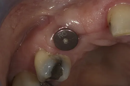 Implant healing abutment used to develop simple emergence profile