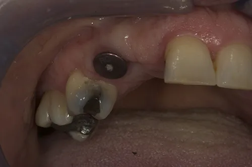 Implant healing abutment in relation to adjacent teeth