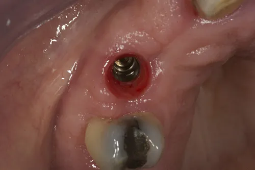 Gum profile after removal of healing abutment