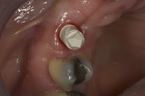 iTero digital scan body fitted to implant fixture