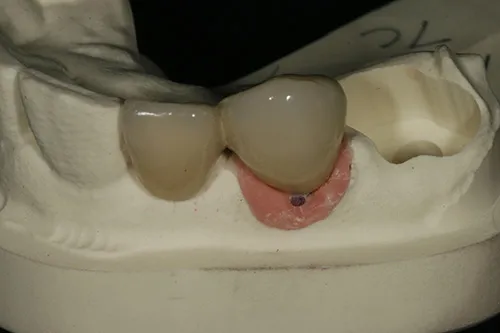 Implant bridge fabricated on iTero model