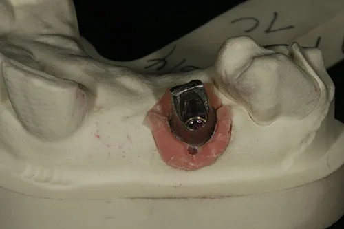 Implant abutment on iTero model