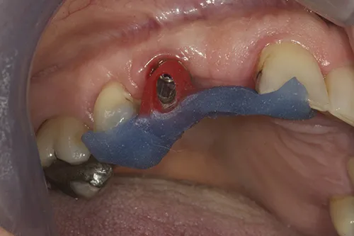 Acrylic jig used to place permanent abutment in situ