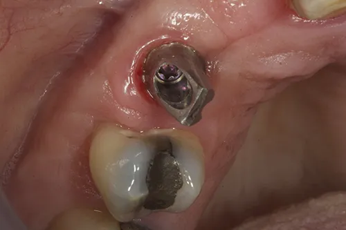 Implant abutment tightened in situ