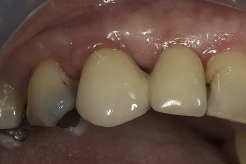 Implant bridge fitted