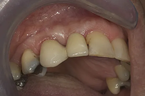 Implant bridge fitted, in relation to the adjacent teeth