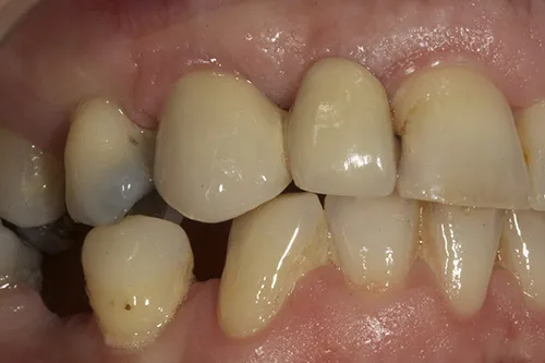 After treatment: Replacing missing teeth with an implant-supported bridge