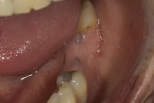 Before treatment: Replacing several teeth with implant crowns