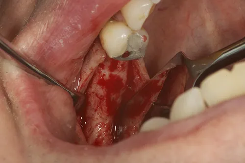 Implant bed exposed