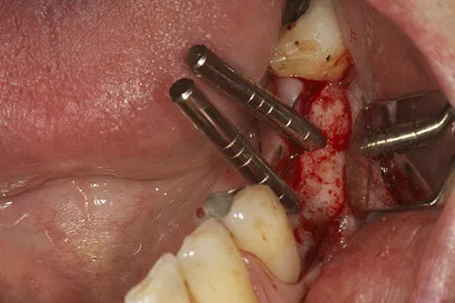 Direction indicators used to ensure correct angulation of prepared site for implant placement