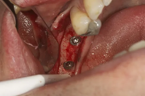 Implant fixtures placed in situ