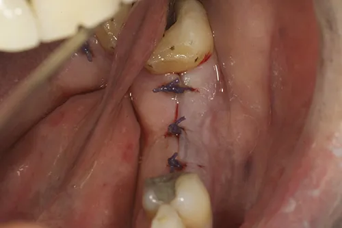 Implant site closed