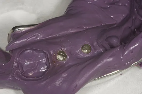 Impression taken of implant fixtures for laboratory communication