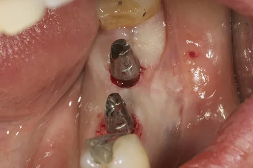 Implant fixtures exposed and permanent abutments tried in