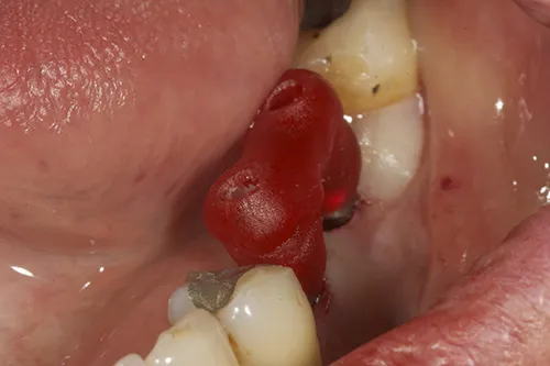 Acrylic jig used to tighten permanent abutments in exact position