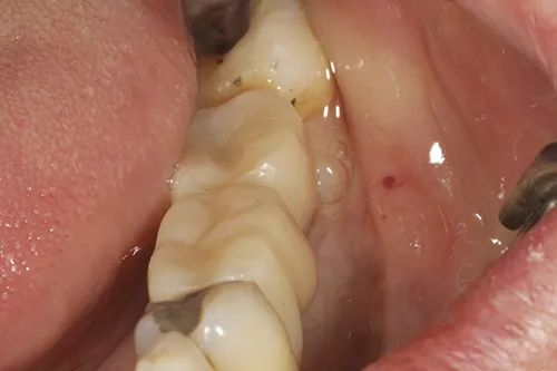 Temporary crowns placed in situ to develop emergence profile