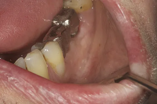Metal framework of permanent crowns impressioned in situ to fabricate exact permanent implant crowns