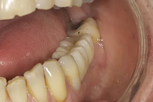 Retracted view of permanent implant crowns in situ