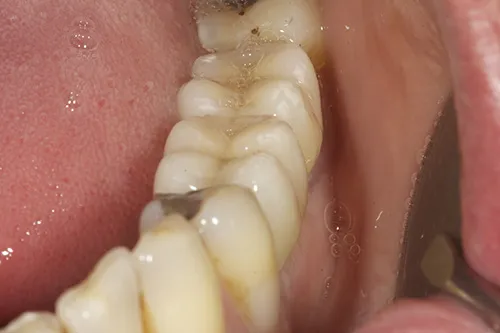 After treatment: Replacing several teeth with implant crowns