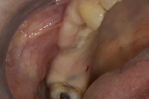 Before treatment: Replacing several teeth with an implant-supported bridge