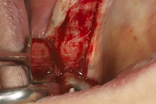 Implant site exposed