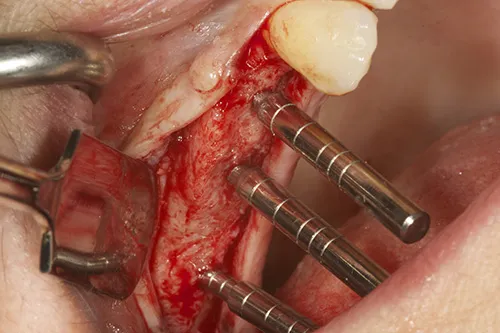 Implant direction indicators used to ensure exact angulations of prepared implant bed