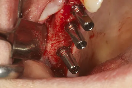 Implant fixtures placed in situ