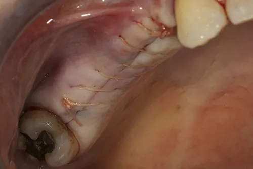 Closed surgical site