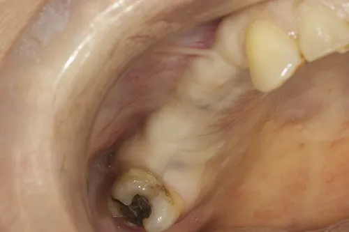 Healed surgical site 8 weeks later