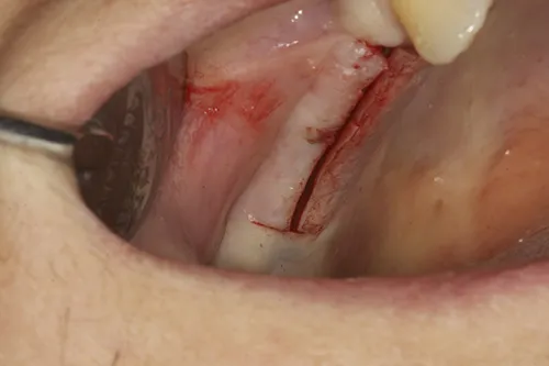 Small incision to expose implant fixture heads
