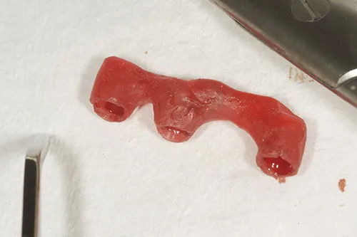 Acrylic positioning jig used to seat permanent implant abutments