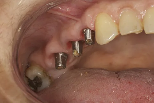 Emergence profiles developed prior to final implant impression