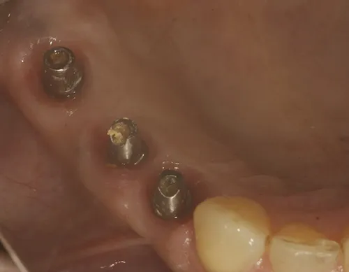 Mirror view of implant abutments and their emergence profile